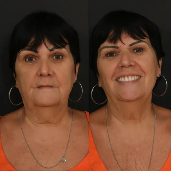 Beige Minimalist Skincare Before and After Instagram Post.png