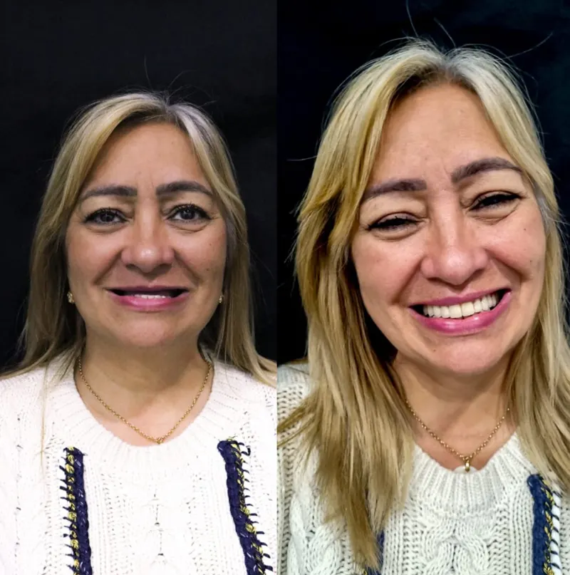 antes e depois jane